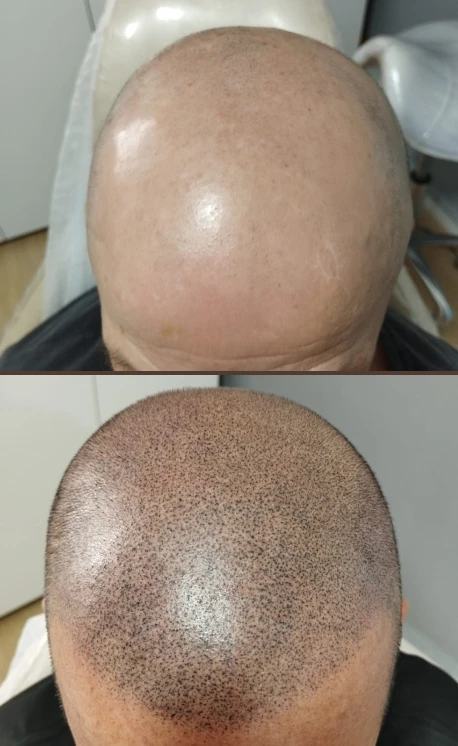 antesdepois_2